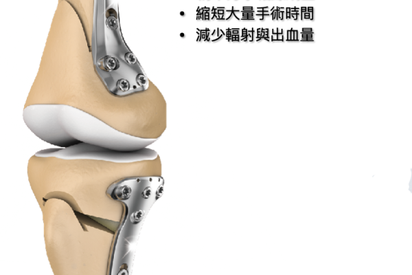 愛派司退化性關節炎矯正產品，採 3D列印精準矯正新技術 愛派司矯正保膝手術，要分食人工關節 3 成商機 2023 Jan